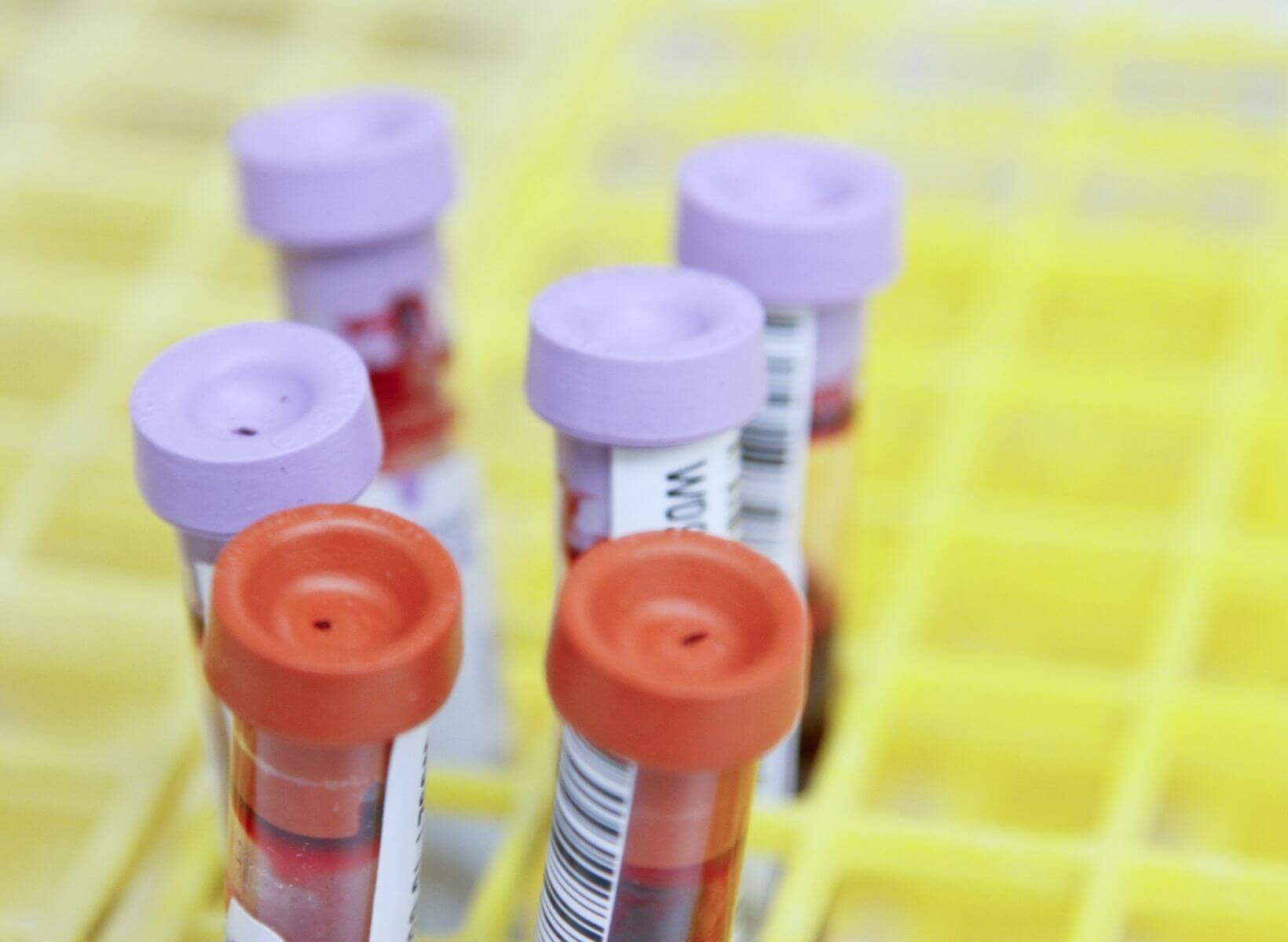 Close up shot of vials of blood drawn from patients to track their blood glucose