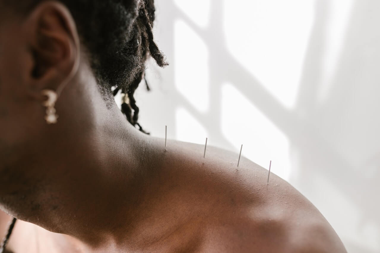 Close-up-of-womans-shoulders-with-acupuncture